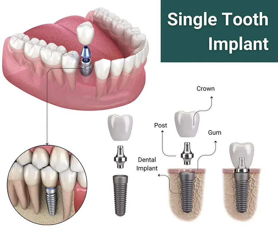 Thailand Implant Procedures Explained Step-by-Step
