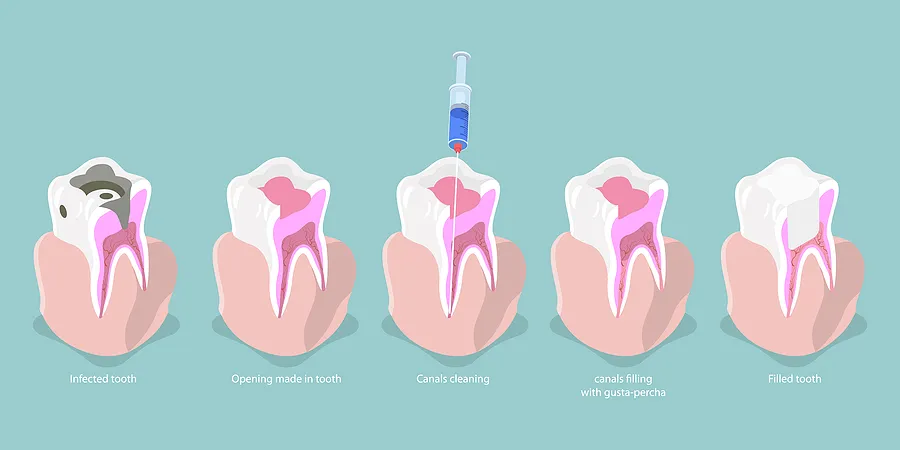 Thailand Gentle Root Canal Techniques for Sensitive Patients