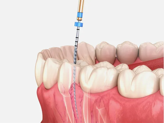 Thailand Root Canal With Advanced Cleaning Systems