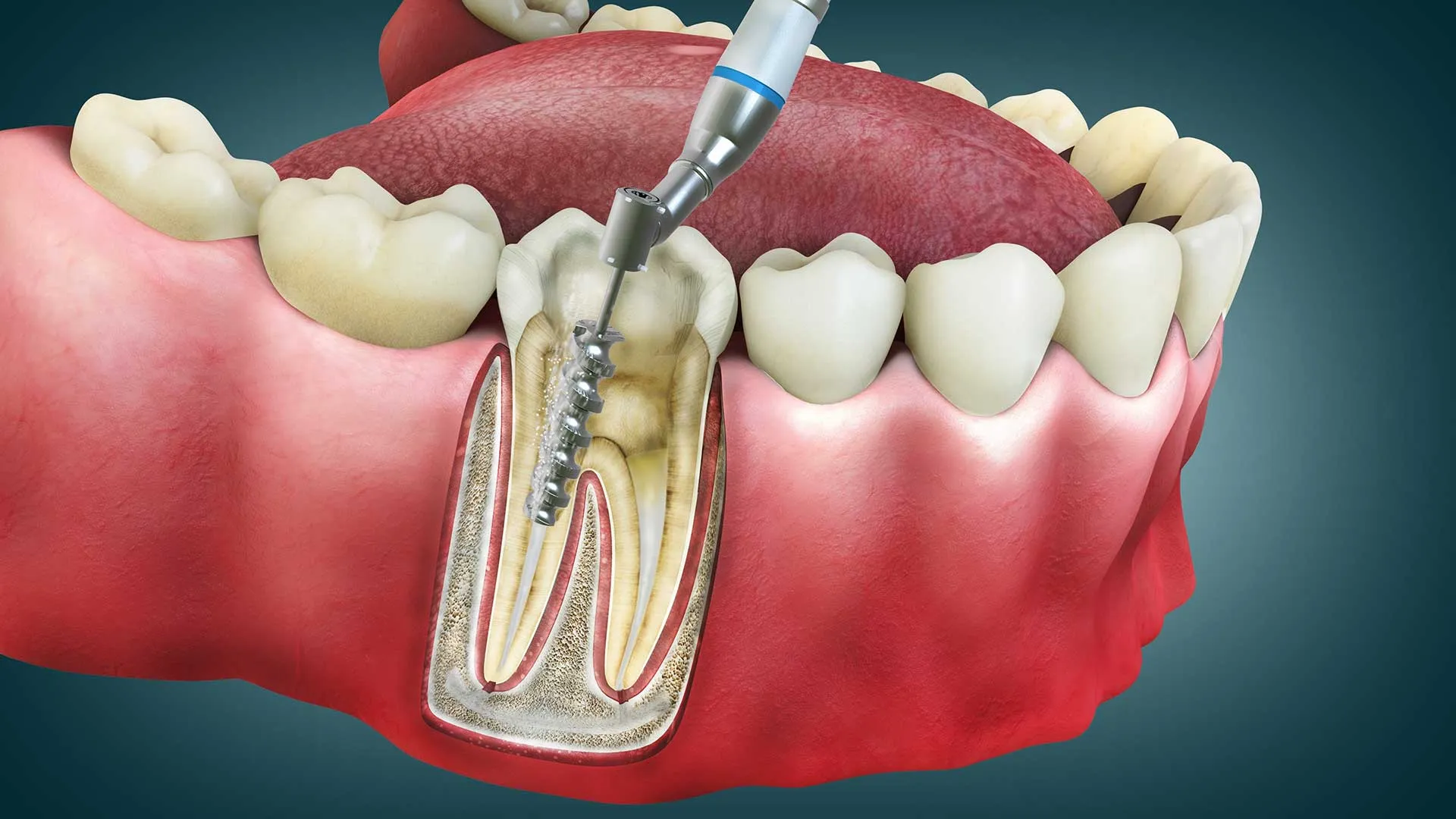 Thailand Root Canal for Fractured Crown