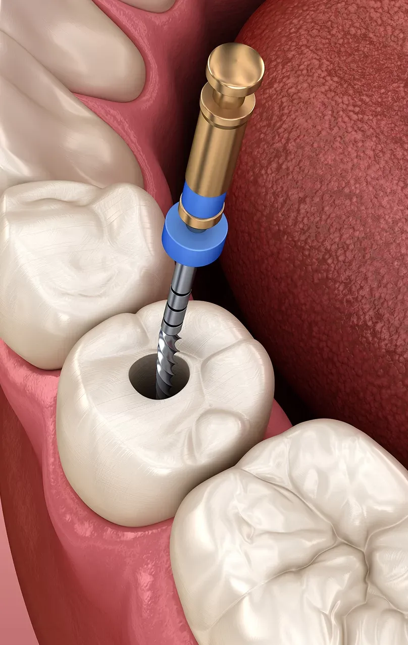 Thailand Root Canal for Teeth With Multiple Roots