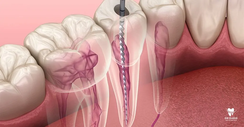 Thailand Root Canal Appointment Checklist