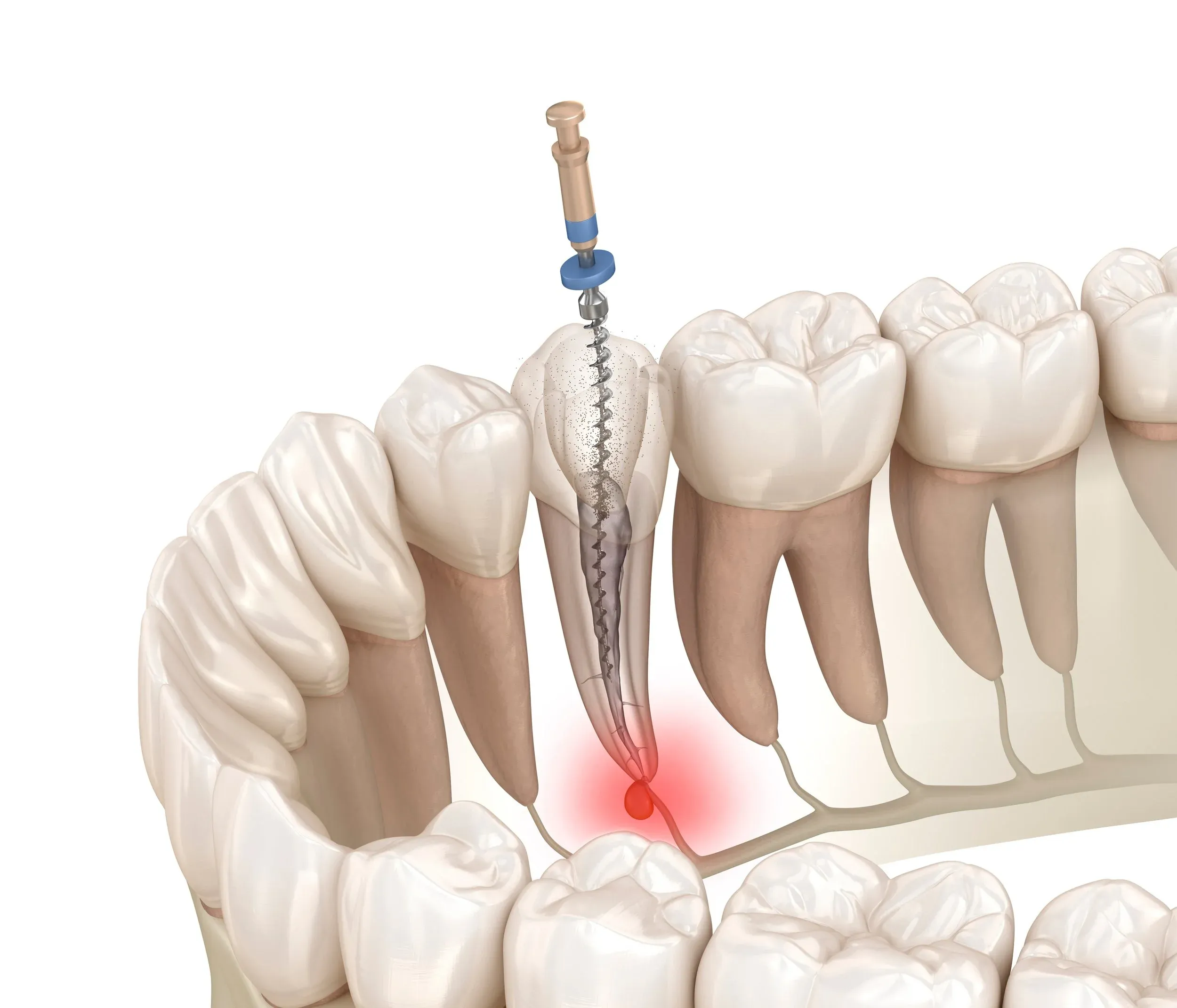 Thailand Root Canal for Tooth Pain While Chewing