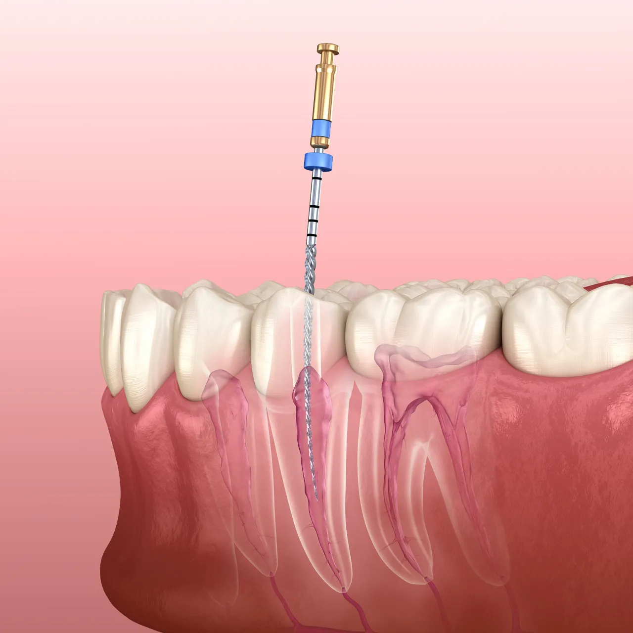 Thailand Root Canal for Dental Tourists in Bangkok