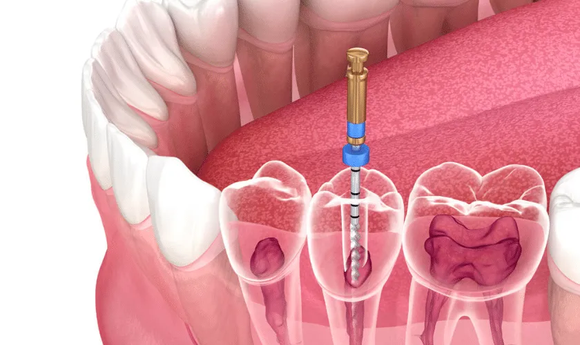 Thailand ReRoot Canal Treatment Explained