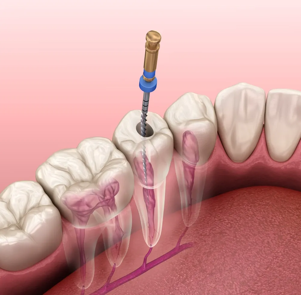 Thailand Root Canal Stepwise Treatment