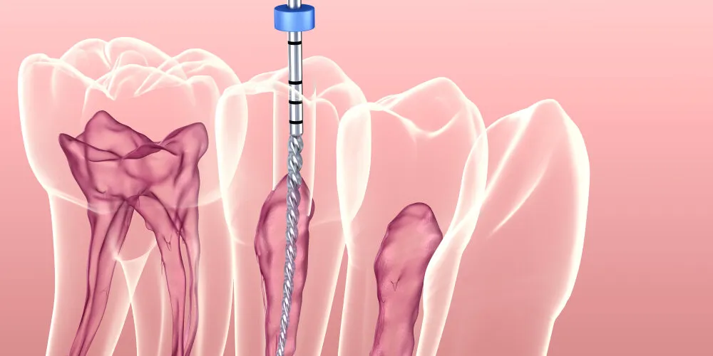 Root Canal Aftercare Tips from Thai Dentists