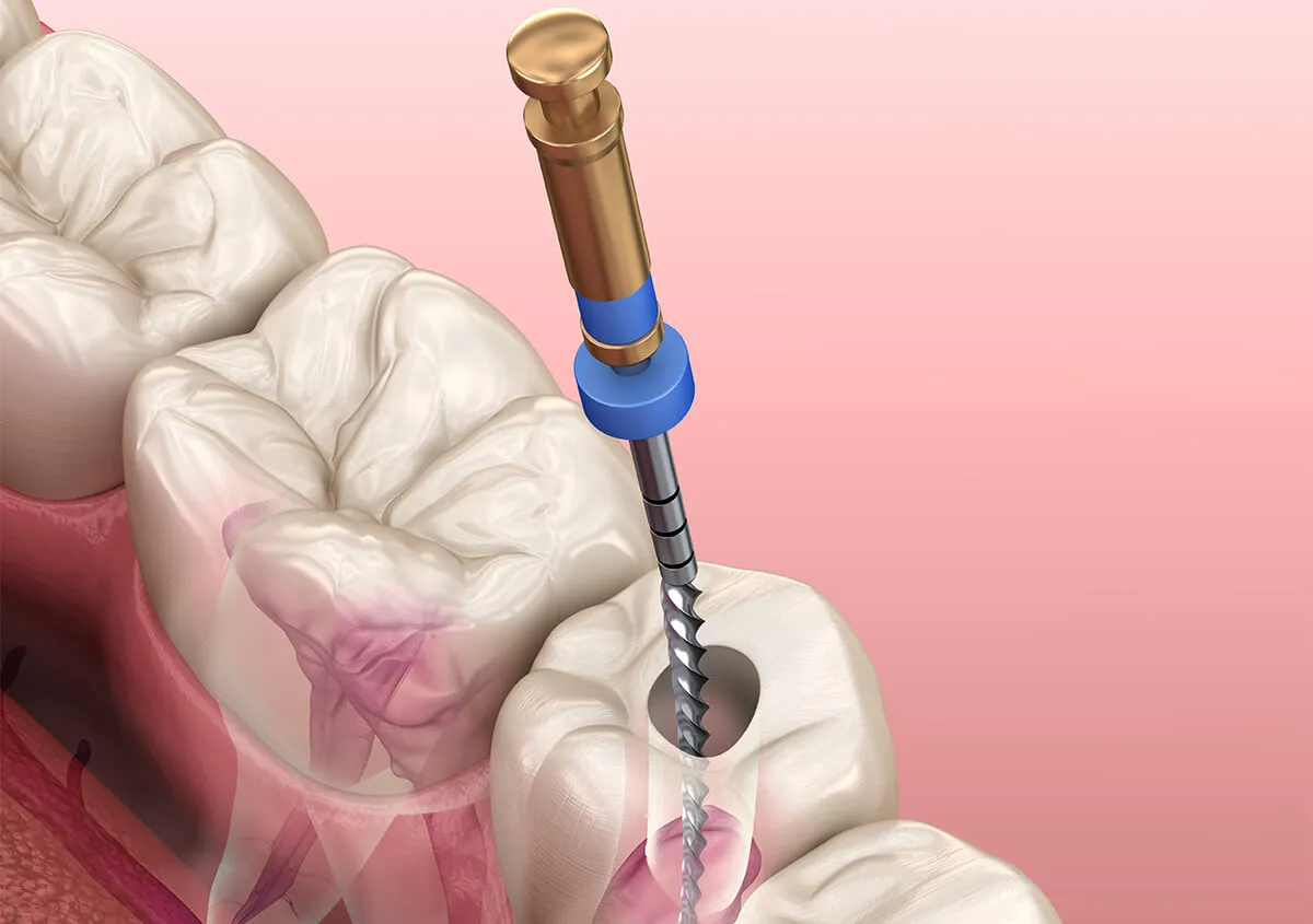 Thailand Root Canal for Long-Standing Toothache