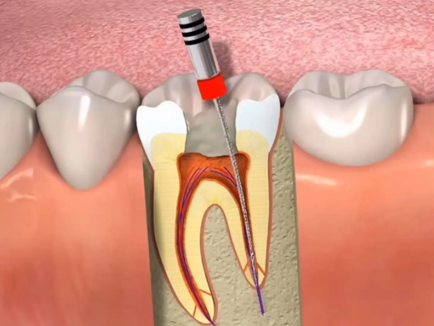 Thailand Root Canal Warranty Details