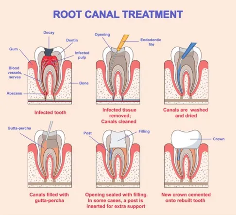 Thailand Root Canal Options for Premolars