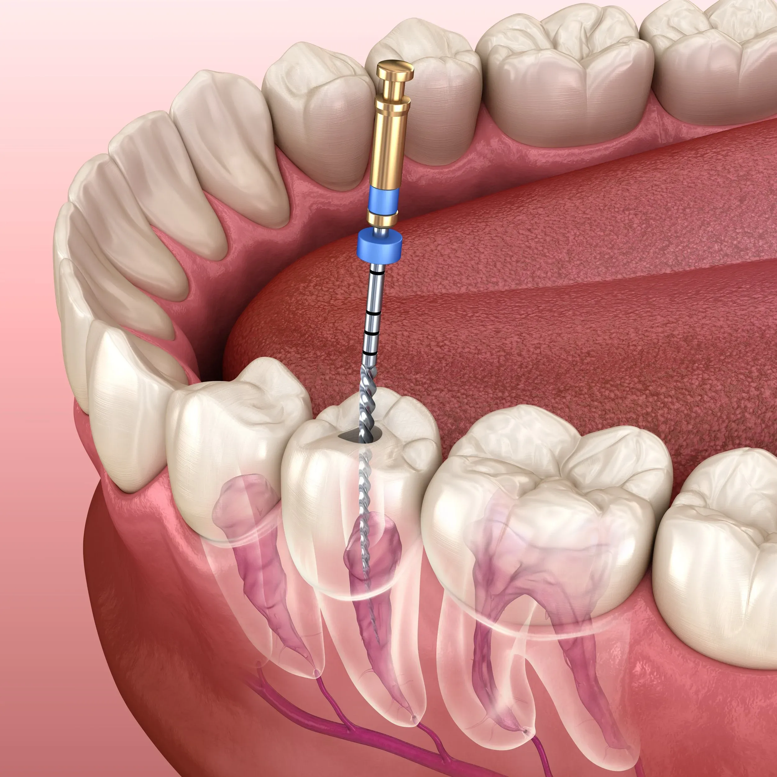 Thailand Single Root Tooth Treatment Cost
