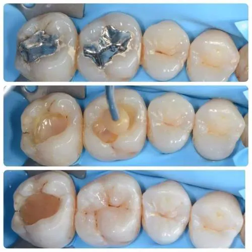 Thailand Root Canal for Severe Nerve Damage
