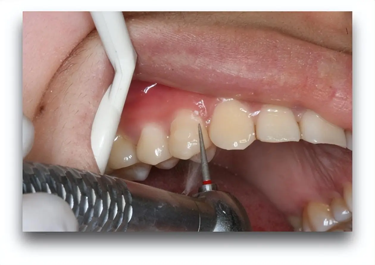 Chiang Mai Dentist Teeth Cleaning Review – What Locals Think