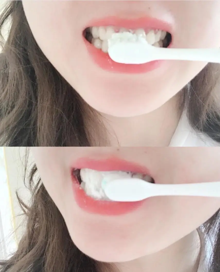 Pattaya Dental Scale and Polish – Budget-Friendly Clinics.