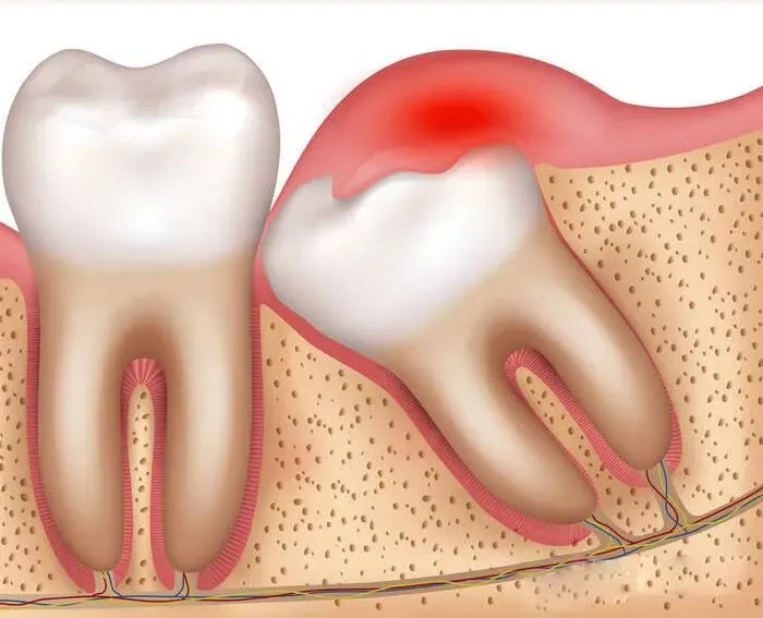 Thailand Tooth Extraction Experience for Overseas Patients Review