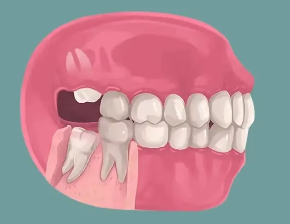 How to Prepare Before Your Thailand Tooth Extraction Appointment