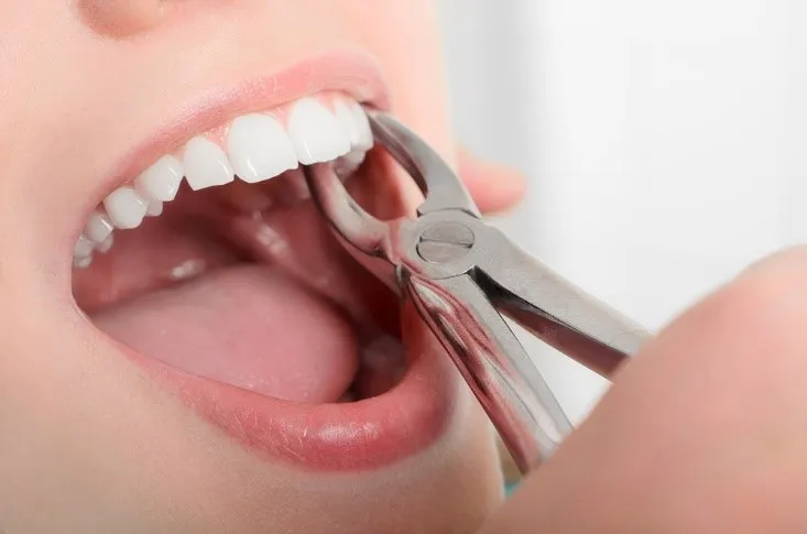 Thailand Tooth Extraction Recovery Tips for Faster Healing Abroad