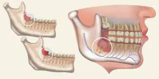 Thailand Tooth Extraction Clinics Offering Smooth Treatment Experience