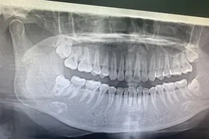 Thailand Tooth Extraction Services With Advanced Dental Technology