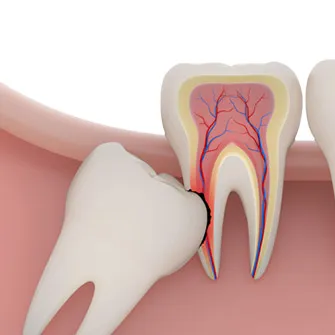 Thailand Tooth Extraction for Removing Teeth With Precision Techniques