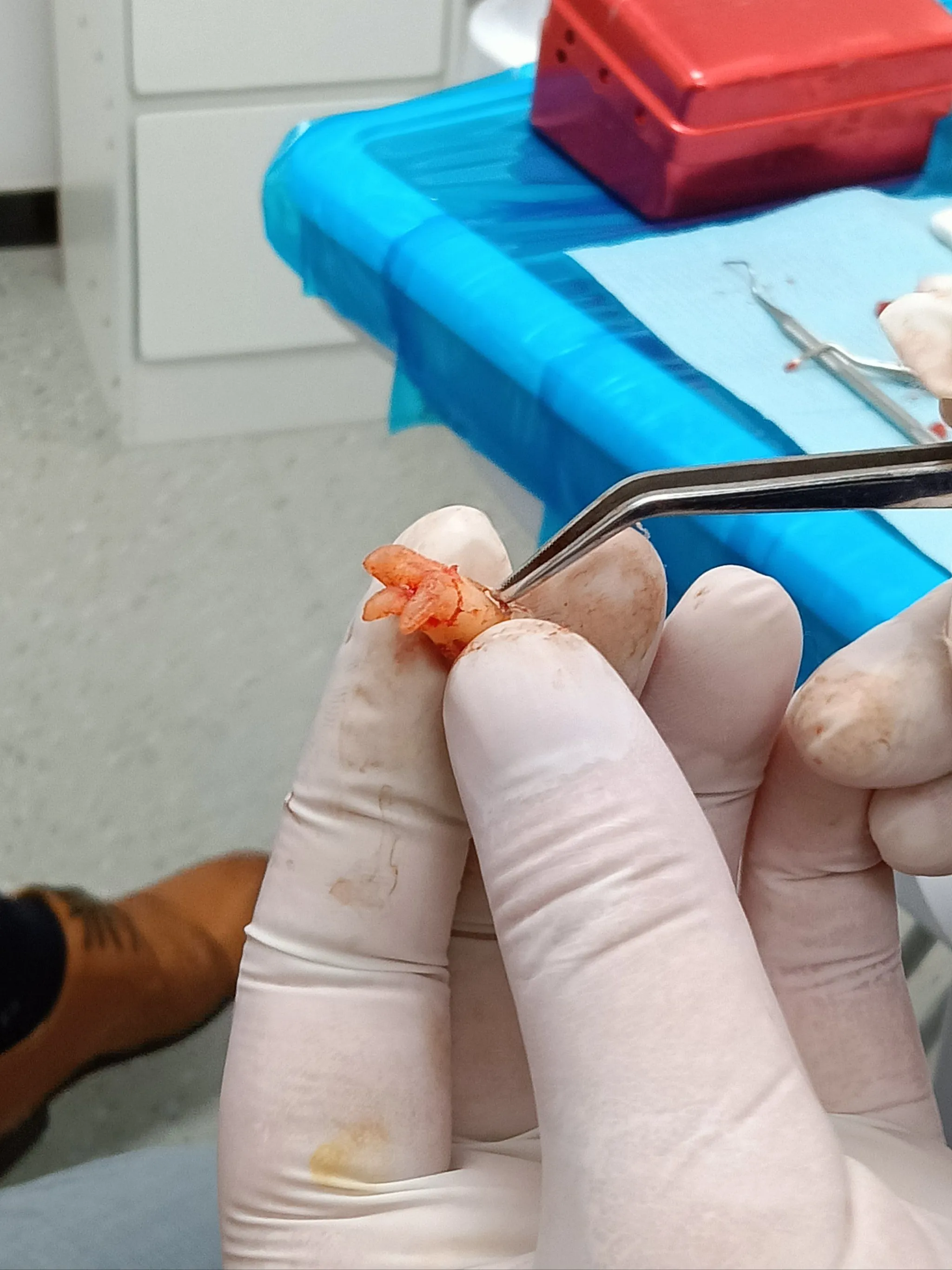 Thailand Tooth Extraction Clinics with Professional Treatment Options