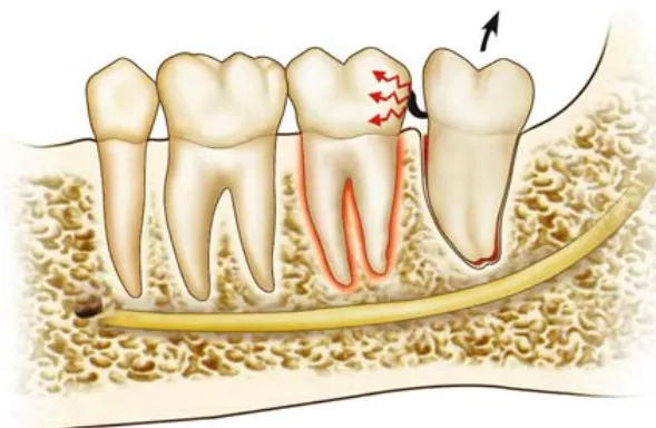 Thailand Tooth Extraction For Travelers Combining Vacation and Treatment