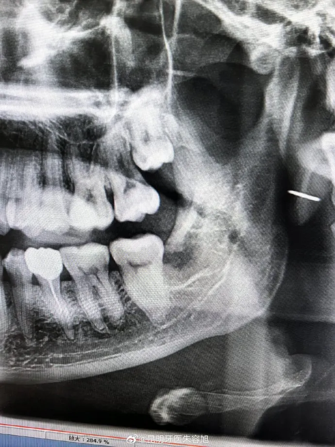 Thailand Tooth Extraction Services With Quick Appointment Availability for Travelers