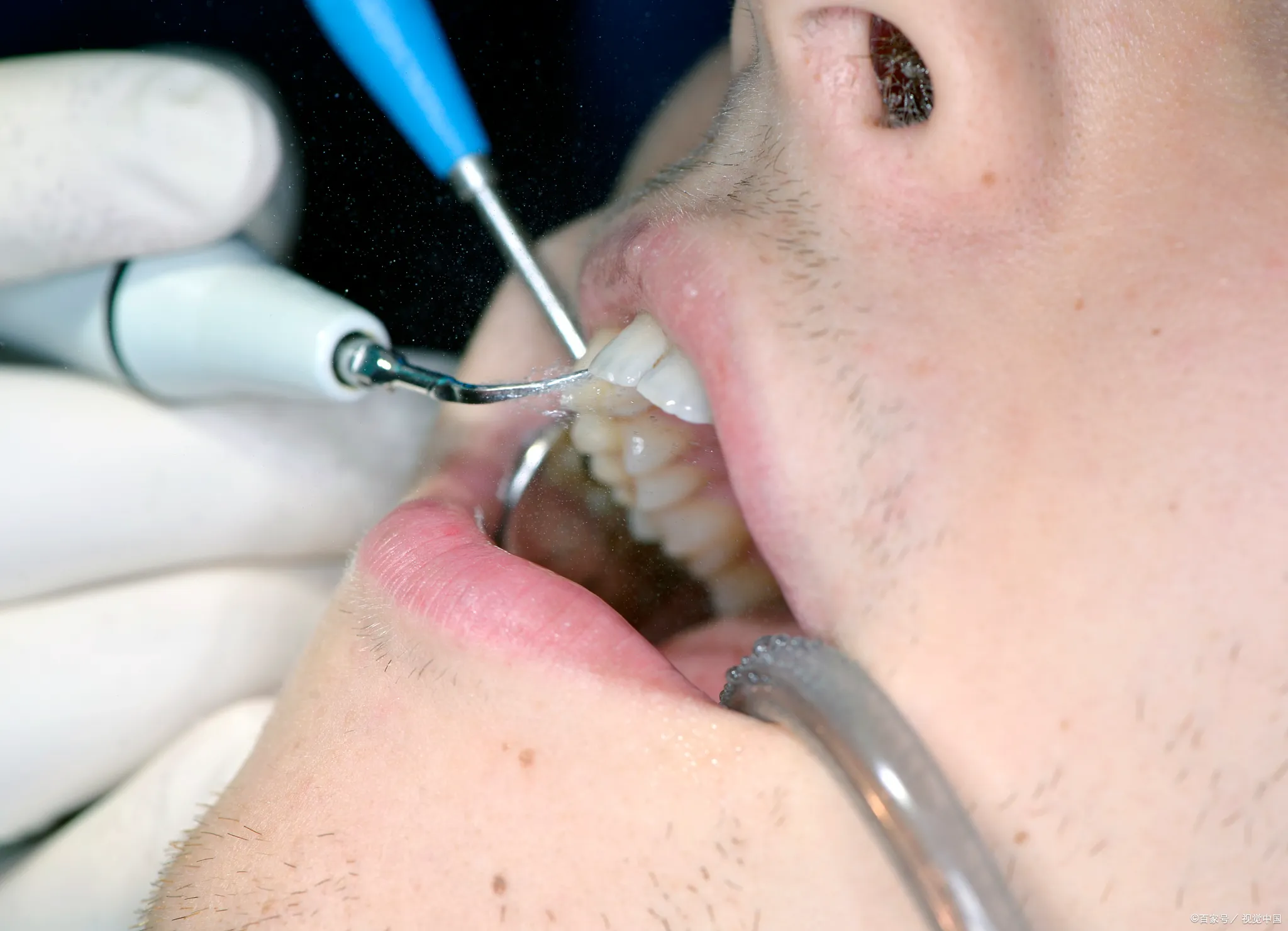 Thailand Tooth Extraction Services With Transparent Treatment Costs