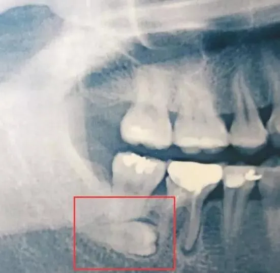 Thailand Tooth Extraction Services With Outstanding Dental Support