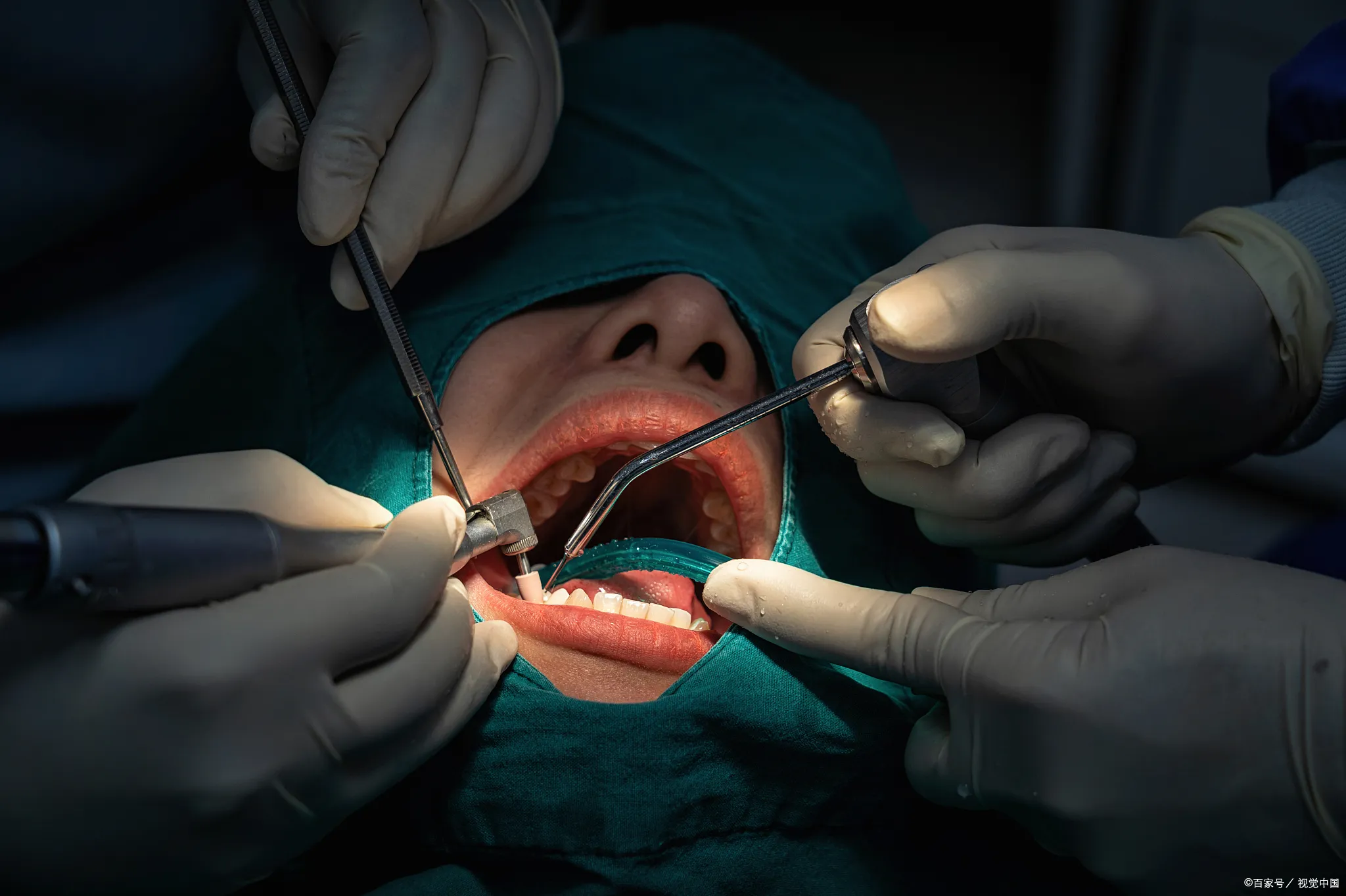 Thailand Tooth Extraction Procedures With Skilled Dental Professionals