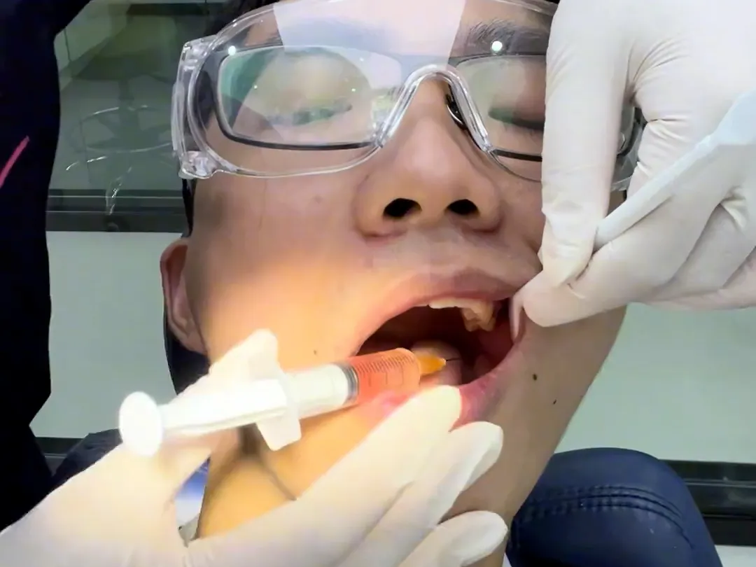 Thailand Tooth Extraction Services for International Dental Patients