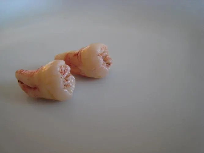 Thailand Tooth Extraction Procedures for International Dental Patients