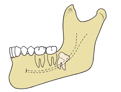 Thailand Tooth Extraction Services for Removing Decayed Teeth Quickly