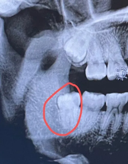 Thailand Tooth Extraction Care for Affordable Cross Border Dentistry