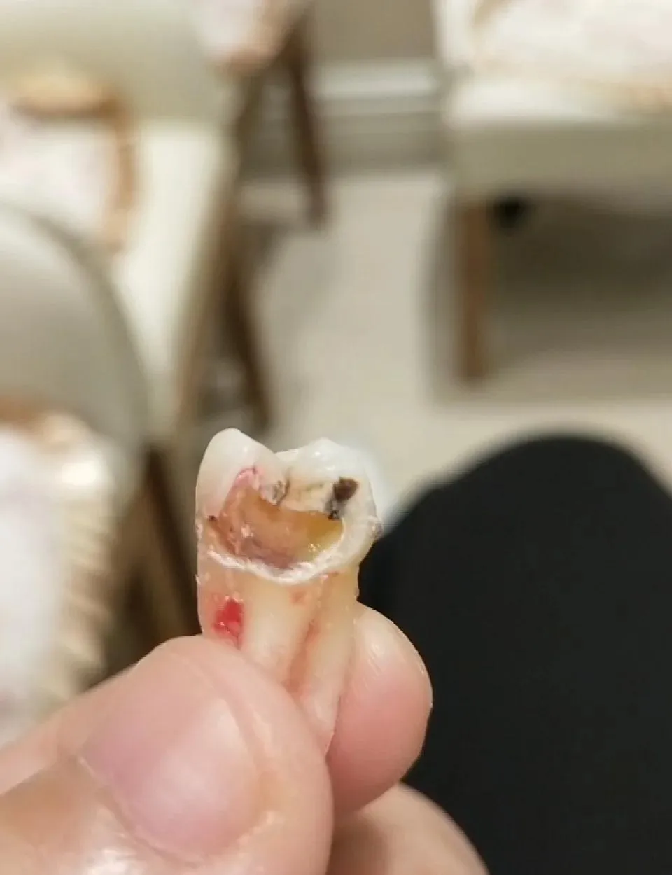 Thailand Tooth Extraction Services With High Quality Patient Support