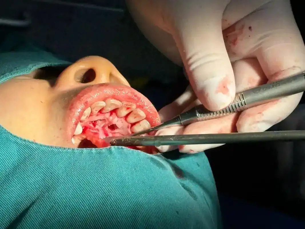 Thailand Tooth Extraction Care for Travelers Seeking Reliable Clinics