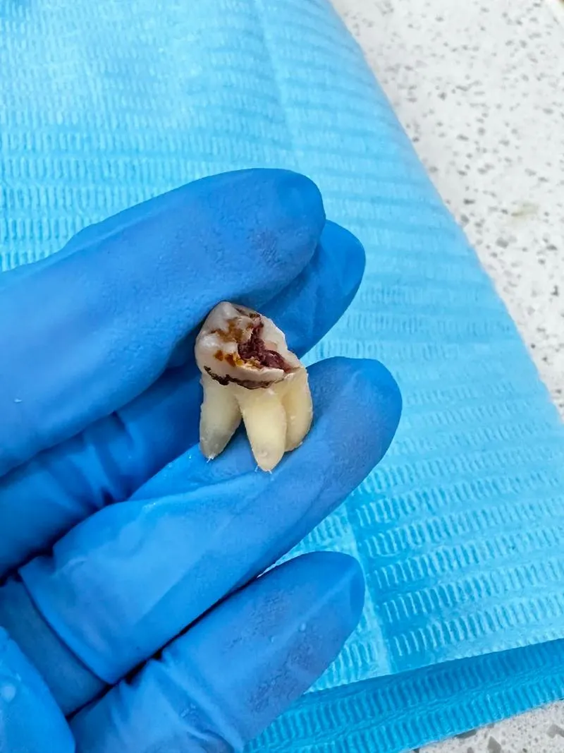 Thailand Tooth Extraction Clinics With Excellent Hygiene Standards