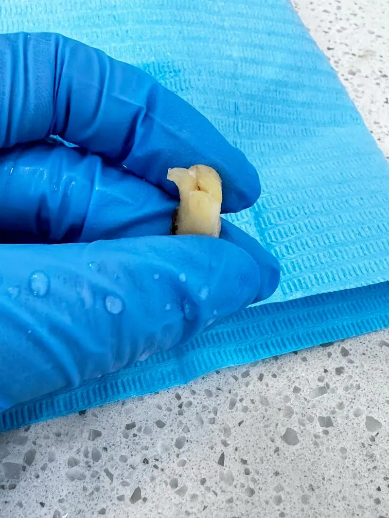 Thailand Tooth Extraction Clinics Offering Trusted Dental Treatments