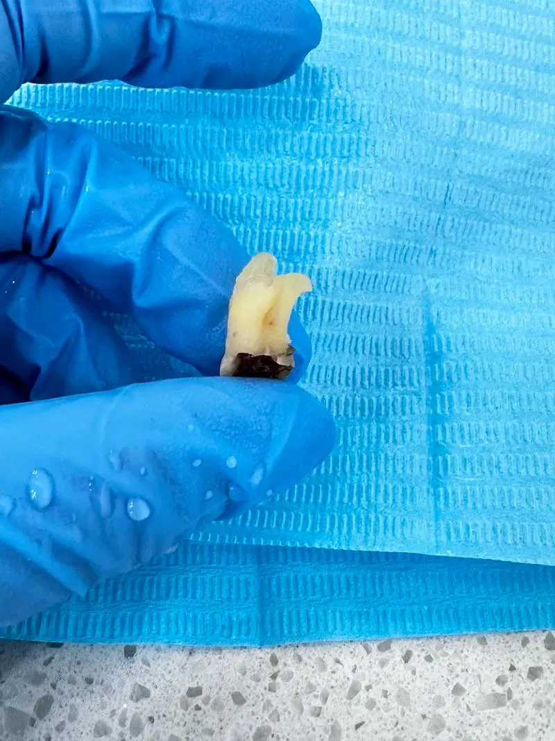 Thailand Tooth Extraction Clinics With Strong Patient Satisfaction Records