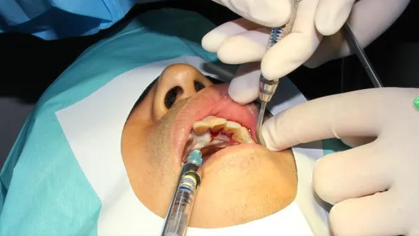Thailand Tooth Extraction Services With Efficient Patient Coordination