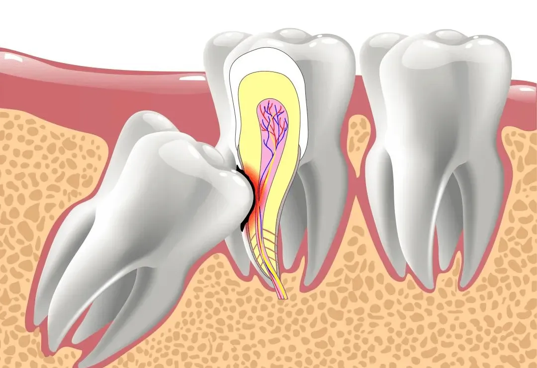 Thailand Tooth Extraction Benefits of Dental Tourism in Thailand