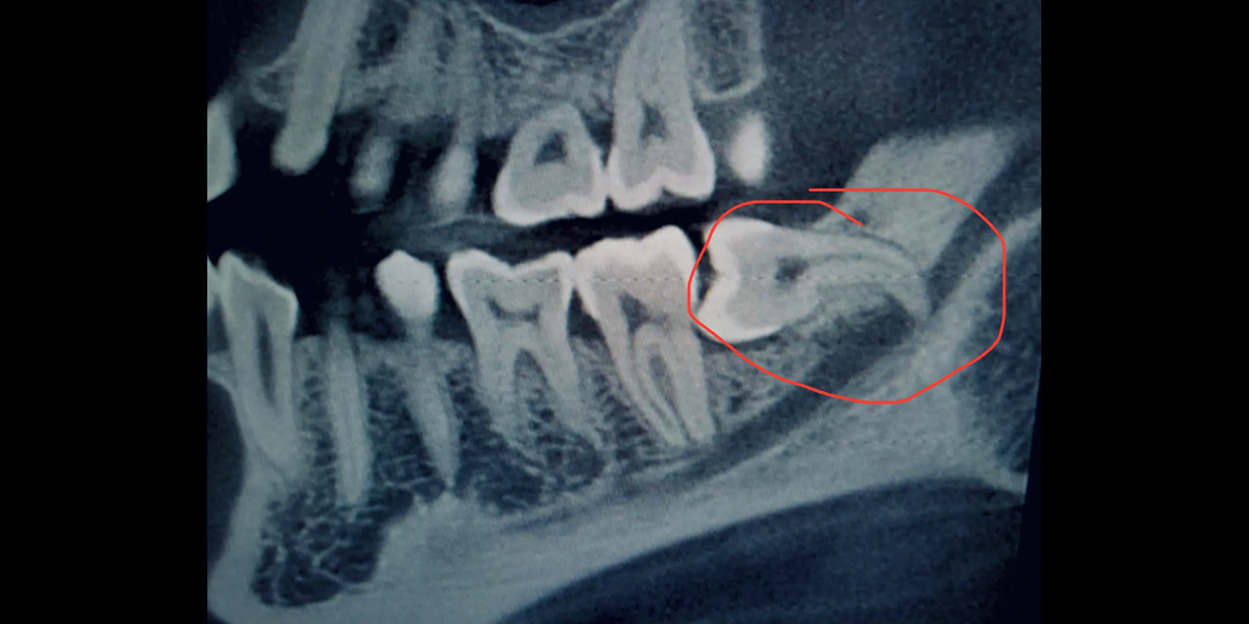 Thailand Tooth Extraction Why Thailand Is Popular for Dental Care
