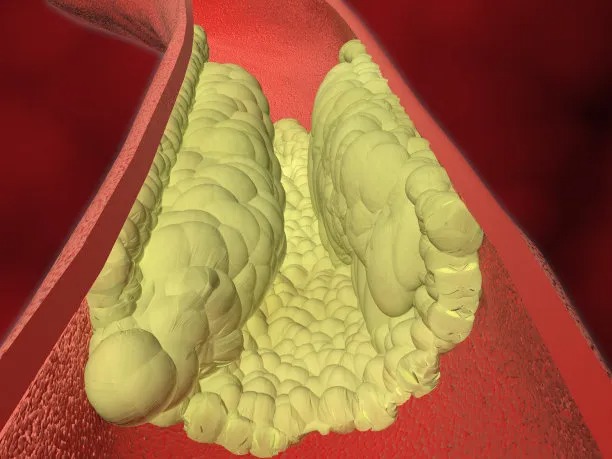 Enhancing Access to Cross-Border Cardiovascular Disease Treatment