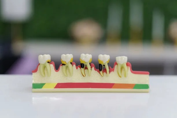 Exploring Affordable Dental Implant Options in Vietnam for a Brighter Smile and Enhanced Oral Health