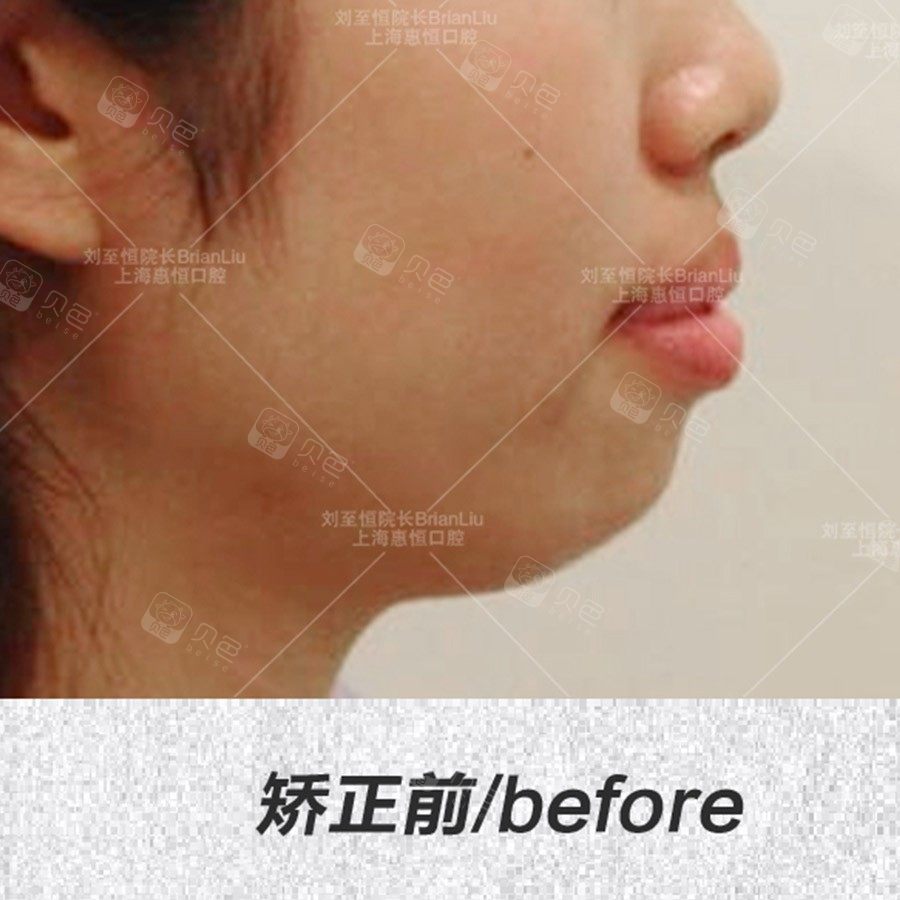 严重骨性龅牙