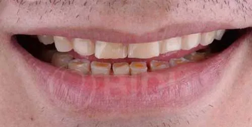 Thailand teeth whitening case,Bangkok cosmetic dentist,professional teeth whitening Bangkok