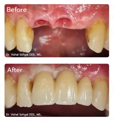 front teeth dental implants,smile restoration with implants,three implant case study