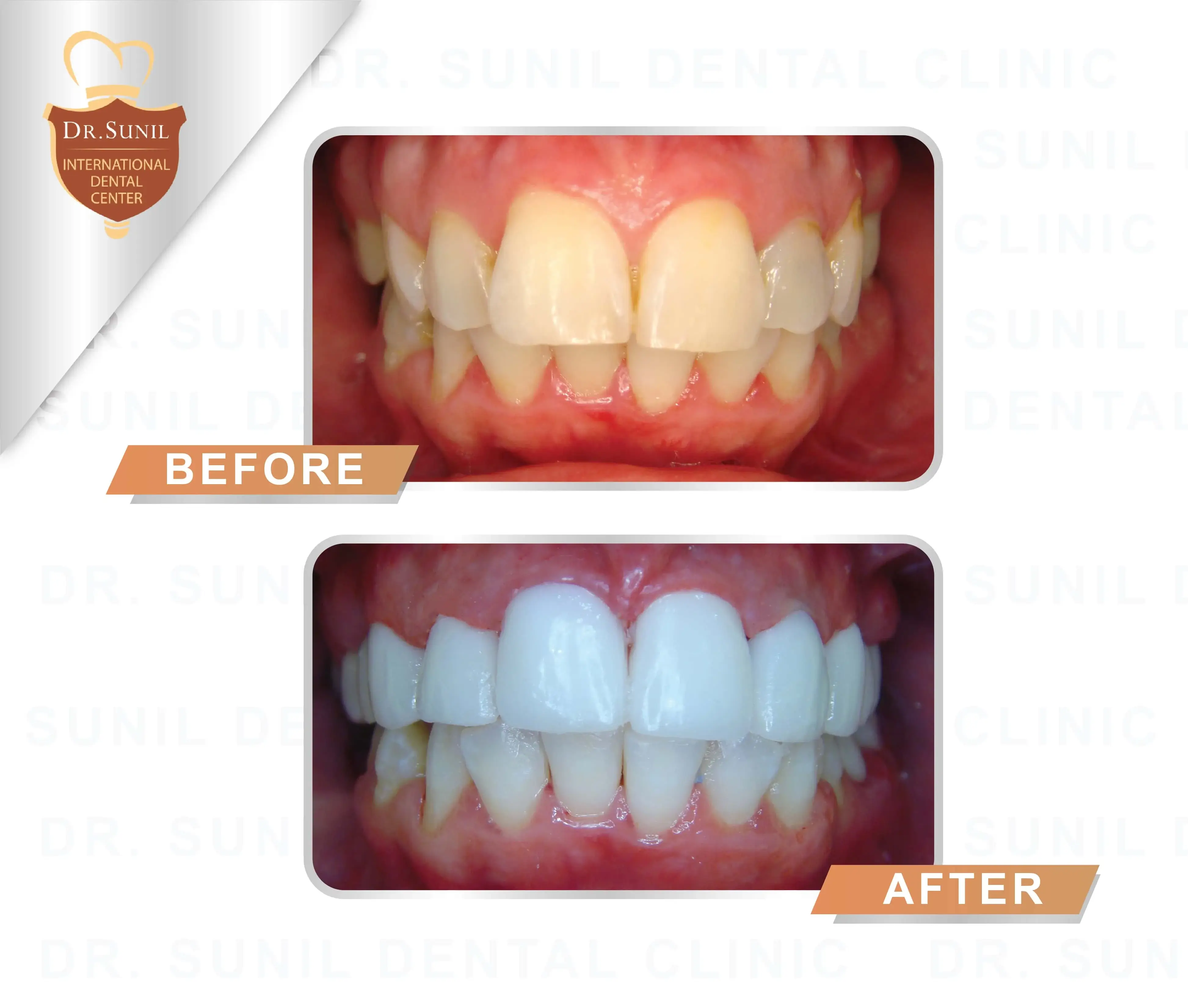 porcelain veneers Thailand,dental veneers before after,smile makeover case Thailand