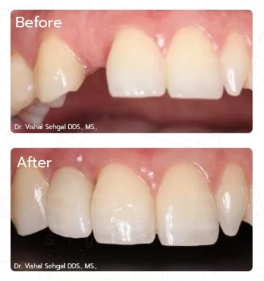 dental implant case,tooth replacement,implant dentistry,missing tooth restoration