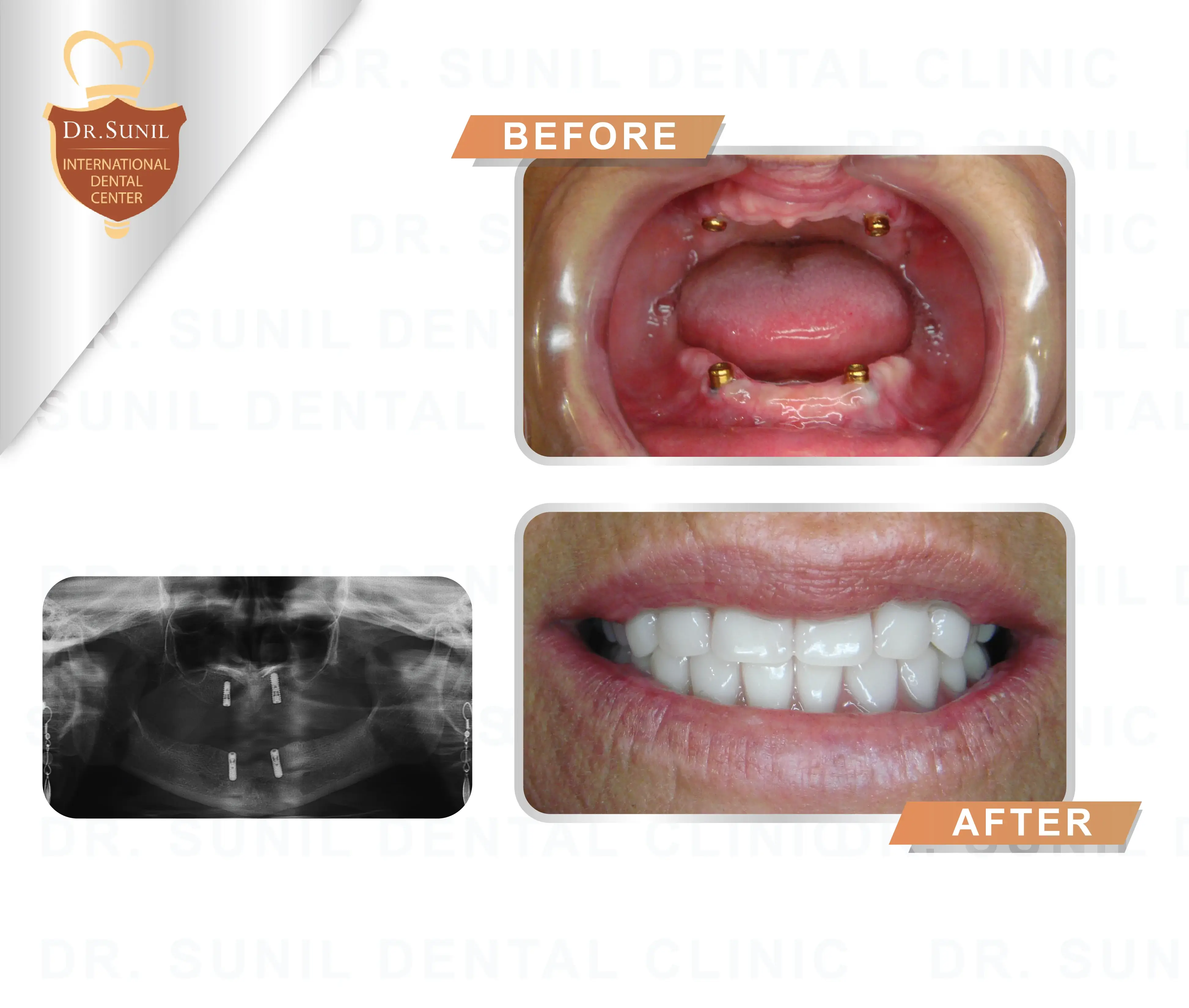 dentures restoration Thailand,false teeth case study,affordable dentures Thailand